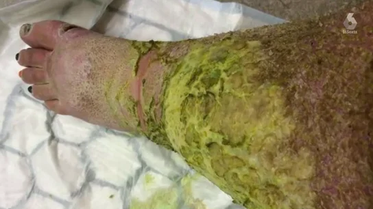 Amputan las piernas a una mujer después de sufrir una brutal infección tras caerse por las escaleras Amputan las piernas a una mujer después de sufrir una brutal infección tras caerse por las escaleras