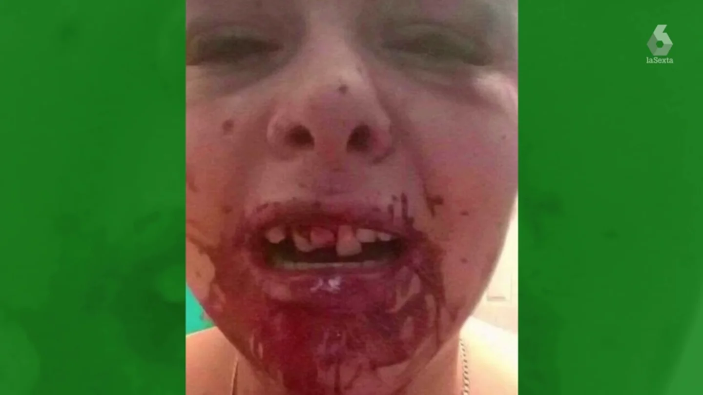 Imagen del rostro desfigurado de una joven después de que su novio le pegase una paliza Imagen del rostro desfigurado de una joven después de que su novio le pegase una paliza