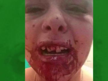 Imagen del rostro desfigurado de una joven después de que su novio le pegase una paliza Imagen del rostro desfigurado de una joven después de que su novio le pegase una paliza