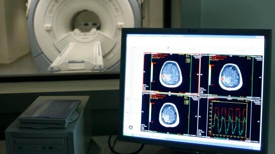 Imagen de un tumor cerebral 