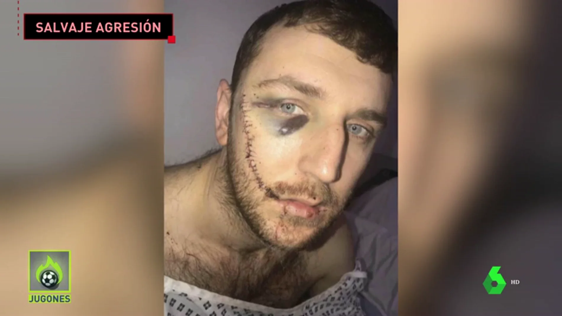 Las terribles heridas de un seguidor del Everton al que rajaron la cara en una pelea entre hooligans: "No me puedo mirar en el espejo"