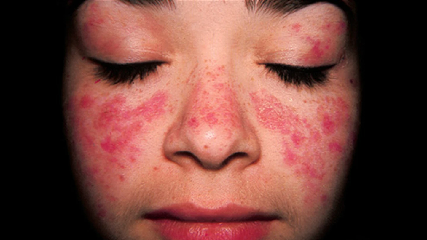 Una paciente con lupus (Archivo) Una paciente con lupus (Archivo)