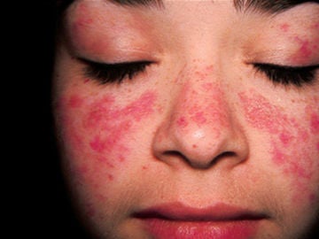 Una paciente con lupus (Archivo) Una paciente con lupus (Archivo)