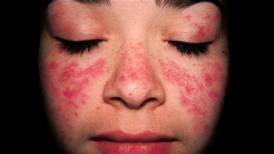 Una paciente con lupus (Archivo) Una paciente con lupus (Archivo)