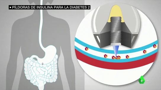 Una píldora de insulina podría acabar con las inyecciones en la diabetes tipo 2 Una píldora de insulina podría acabar con las inyecciones en la diabetes tipo 2