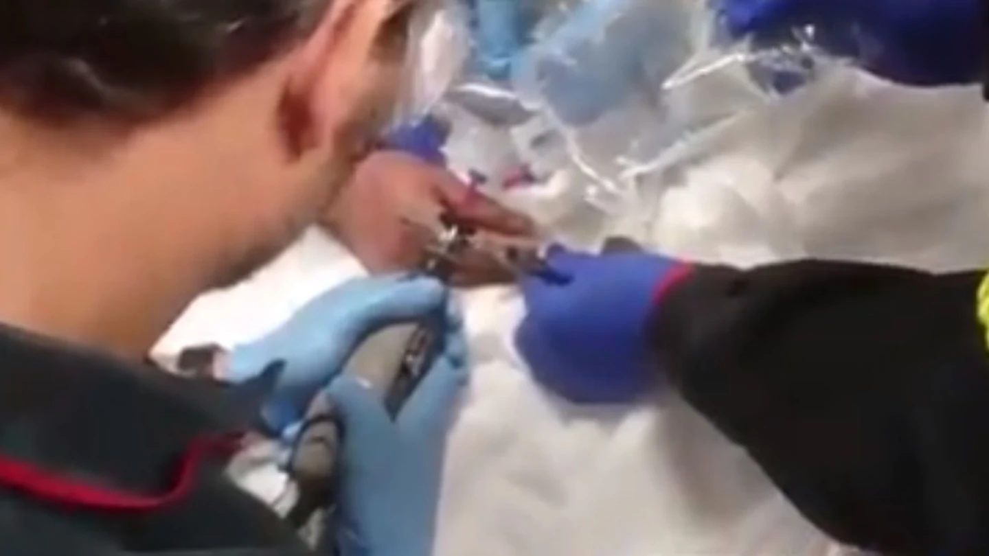 Corte de precisión para quitar el anillo de un hombre Corte de precisión para quitar el anillo de un hombre