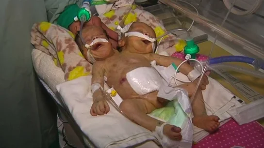 Los dos siameses de Yemen durante su estancia en el hospital La llamada desesperada para salvar a dos siameses de Yemen que luchan por sobrevivir en medio de la peor crisis humanitaria