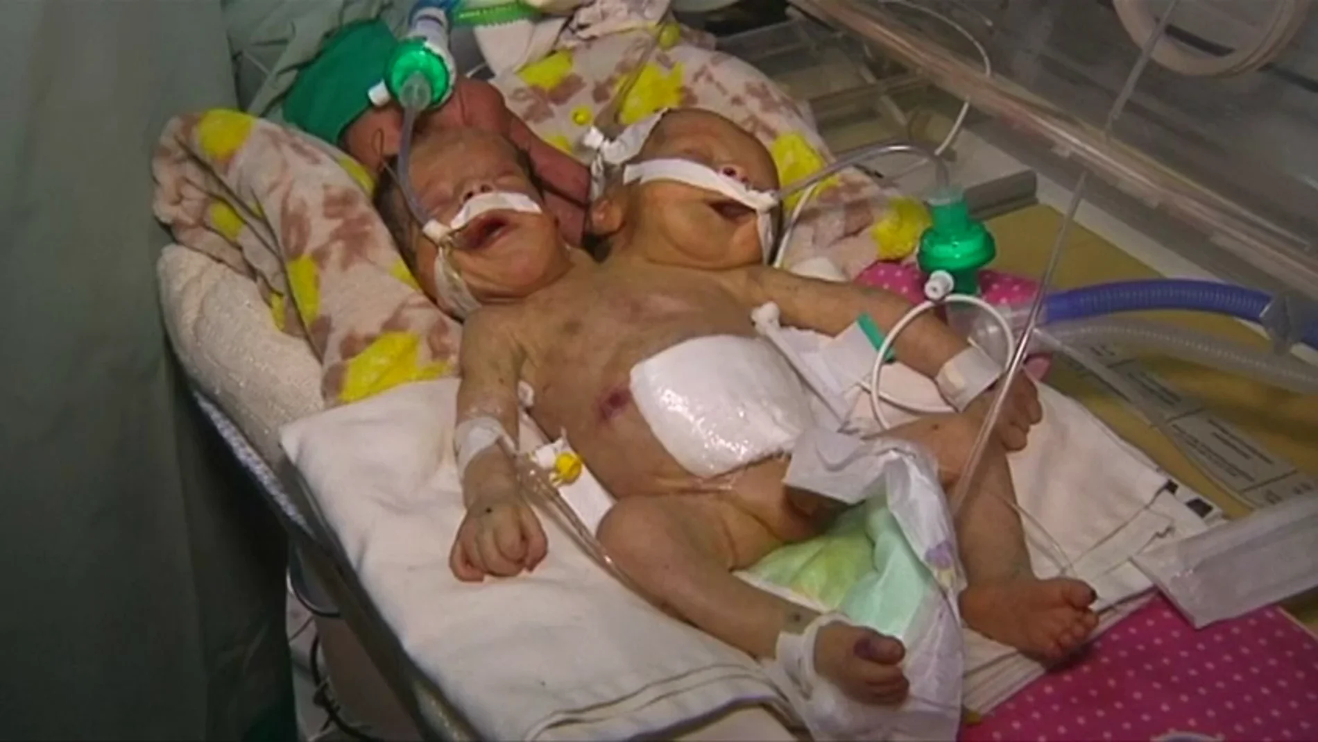 Los dos siameses de Yemen durante su estancia en el hospital