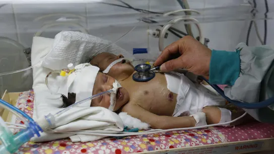 Los siameses de Yemen durante su estancia en el hospital Los siameses de Yemen durante su estancia en el hospital