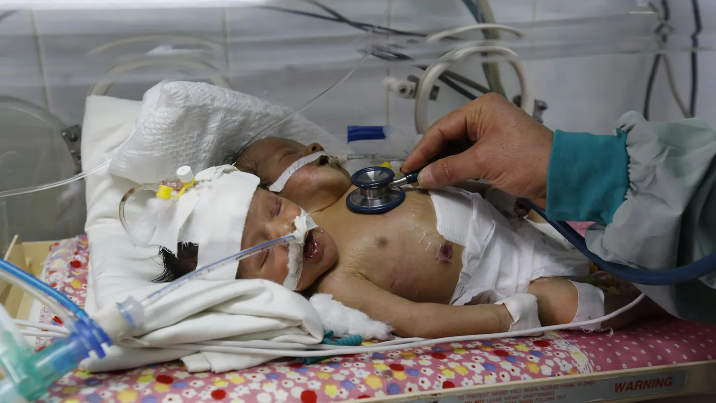 Los siameses de Yemen durante su estancia en el hospital Los siameses de Yemen durante su estancia en el hospital