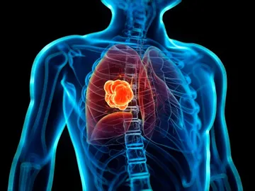 Cáncer de pulmón Cáncer de pulmón