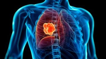 C&aacute;ncer de pulm&oacute;n