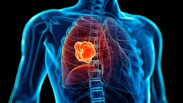 Cáncer de pulmón Cáncer de pulmón