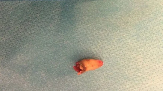 El diente que los médicos extrajeron del orificio nasal El diente que los médicos extrajeron del orificio nasal