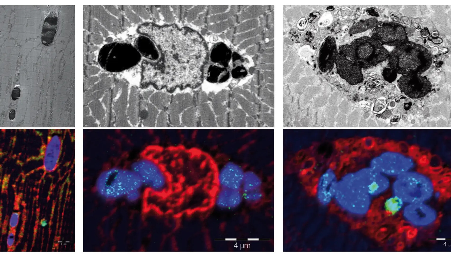 Descubren una nueva enfermedad muscular causada por una mutacion genetica