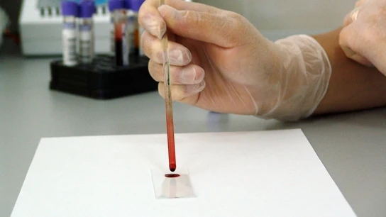 Análisis de una muestra de sangre en un laboratorio Análisis de una muestra de sangre en un laboratorio