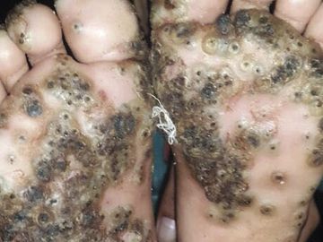 Imagen de los pies de la paciente con tungiasis. Imagen de los pies de la paciente con tungiasis.