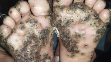 Imagen de los pies de la paciente con tungiasis.