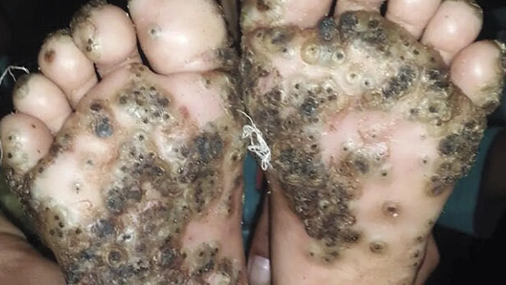 Imagen de los pies de la paciente con tungiasis.