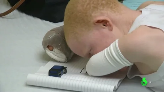 La dura realidad de ser albino en África: torturas, secuestros y exclusión social por nacer sin pigmento en la piel La dura realidad de ser albino en África: torturas, secuestros y exclusión social por nacer sin pigmento en la piel