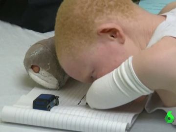 La dura realidad de ser albino en África: torturas, secuestros y exclusión social por nacer sin pigmento en la piel La dura realidad de ser albino en África: torturas, secuestros y exclusión social por nacer sin pigmento en la piel