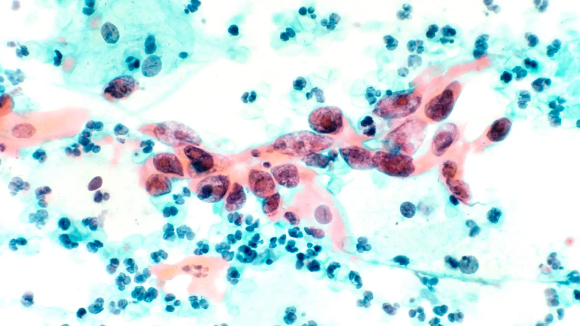 Carcinoma de cuello uterino