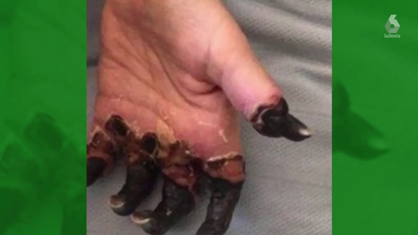 Amputan las piernas y la mano de una mujer por un diagnóstico erróneo de su médico Amputan las piernas y la mano de una mujer por un diagnóstico erróneo de su médico