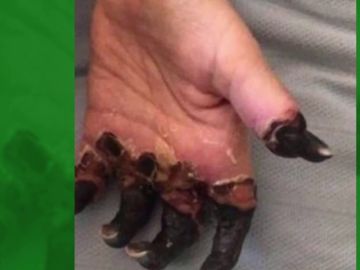 Amputan las piernas y la mano de una mujer por un diagnóstico erróneo de su médico Amputan las piernas y la mano de una mujer por un diagnóstico erróneo de su médico