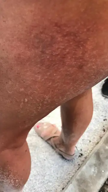 Imagen de una mujer quemada tras usar el tobogán Imagen de una mujer quemada tras usar el tobogán