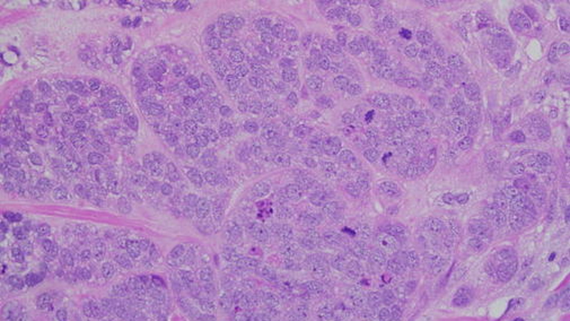 Mecanismo de acción de la primera nanoterapia basada en el uso de un anticuerpo no modificado dirigido contra una proteína intracelular. /UAM-USC