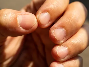 Morderte las uñas puede poner en peligro tu salud Morderte las uñas puede poner en peligro tu salud