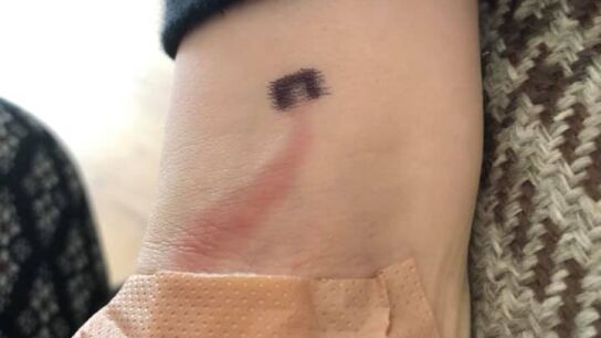 Una madre salva la vida a su hijo de ocho a&ntilde;os tras reconocer una peligrosa mancha en su brazo