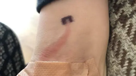 Una madre salva la vida a su hijo de ocho años tras reconocer una peligrosa mancha en su brazo Una madre salva la vida a su hijo de ocho años tras reconocer una peligrosa mancha en su brazo