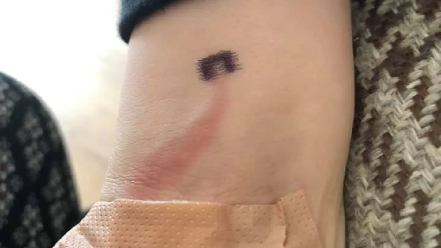 Una madre salva la vida a su hijo de ocho años tras reconocer una peligrosa mancha en su brazo Una madre salva la vida a su hijo de ocho años tras reconocer una peligrosa mancha en su brazo
