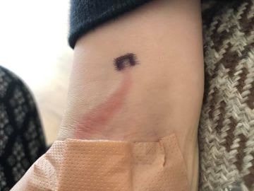 Una madre salva la vida a su hijo de ocho años tras reconocer una peligrosa mancha en su brazo Una madre salva la vida a su hijo de ocho años tras reconocer una peligrosa mancha en su brazo