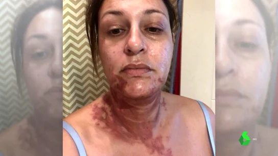 Dos mujeres sufren quemaduras por todo el cuerpo debido a un robot de cocina Dos mujeres sufren quemaduras por todo el cuerpo debido a un robot de cocina