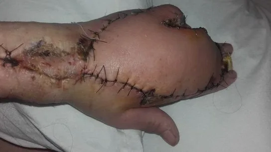 El brazo de la mujer tras ser sometida a una operación El brazo de la mujer tras ser sometida a una operación