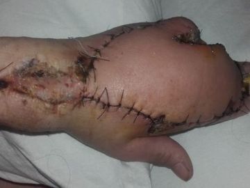 El brazo de la mujer tras ser sometida a una operación El brazo de la mujer tras ser sometida a una operación