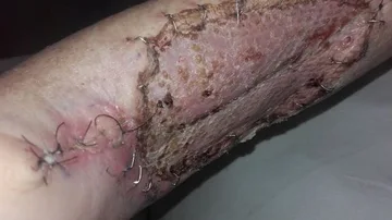 El brazo de la mujer tras ser atacada por un gato