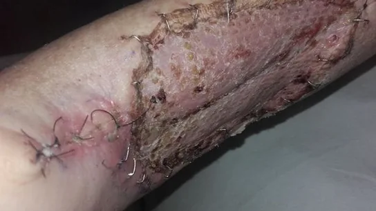 El brazo de la mujer tras ser atacada por un gato El brazo de la mujer tras ser atacada por un gato