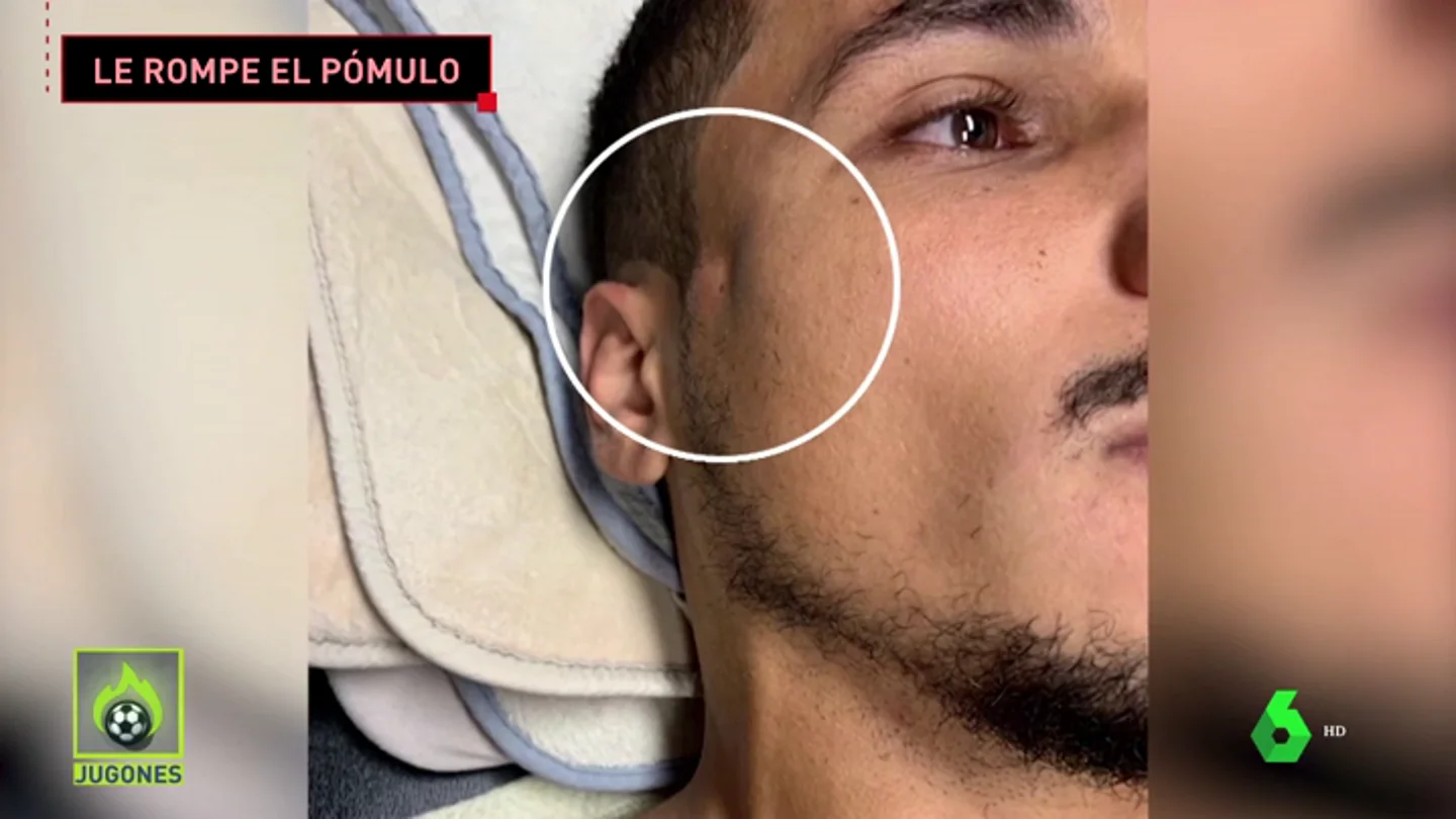 Impresiona: Ibrahimović le parte el pómulo a un rival de un brutal codazo Impresiona: Ibrahimović le parte el pómulo a un rival de un brutal codazo