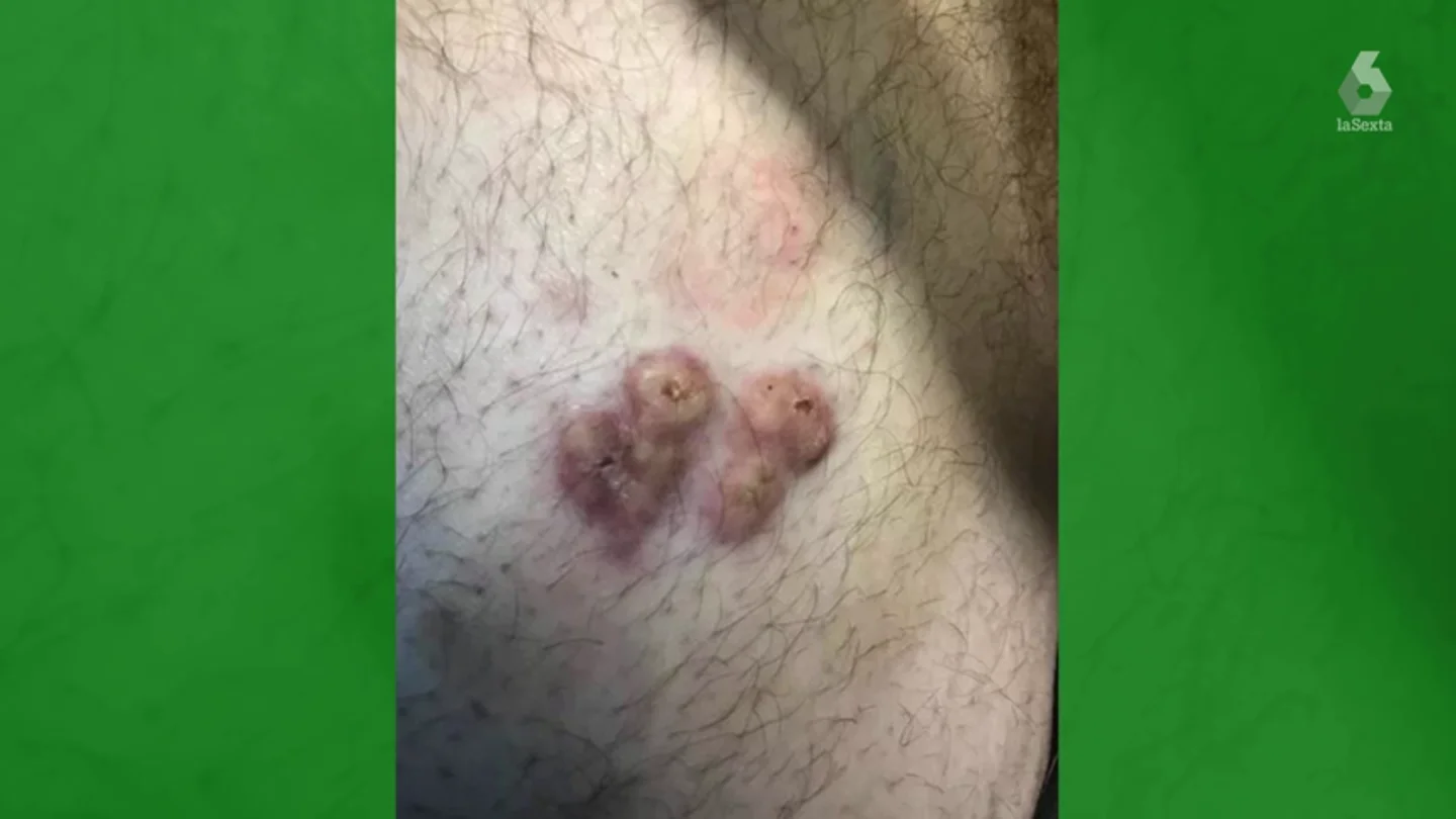 Creyó que se trataba de un pelo encarnado pero resultó ser un tipo de cáncer sin cura Creyó que se trataba de un pelo encarnado pero resultó ser un tipo de cáncer sin cura.