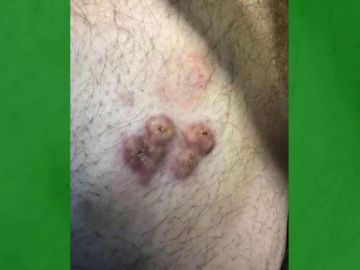Creyó que se trataba de un pelo encarnado pero resultó ser un tipo de cáncer sin cura Creyó que se trataba de un pelo encarnado pero resultó ser un tipo de cáncer sin cura