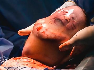 Imagen del bebé dentro del saco amniótico
