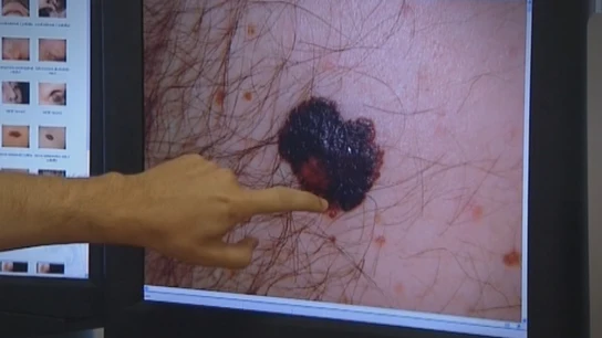 Imagen de un melanoma Imagen de un melanoma