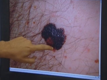 Imagen de un melanoma Imagen de un melanoma