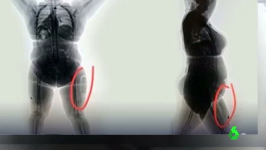 Interceptan a una mujer que pretendía viajar a España con cocaína implantada en la pierna Interceptan a una mujer que pretendía viajar a España con cocaína implantada en la pierna