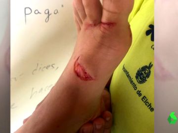 Un pez golfar muerde a una bañista en Alicante Un pez golfar muerde a una bañista en Alicante
