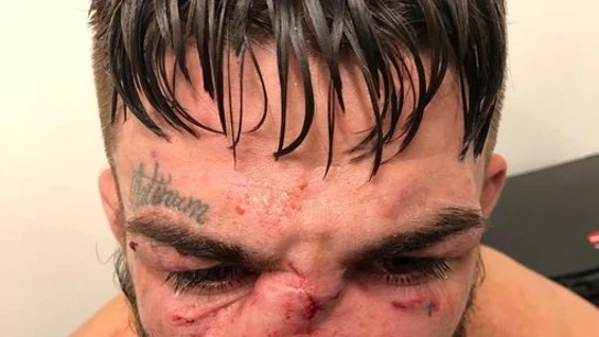 La escalofriante lesión de un luchador de la UFC La escalofriante lesión de un luchador de la UFC