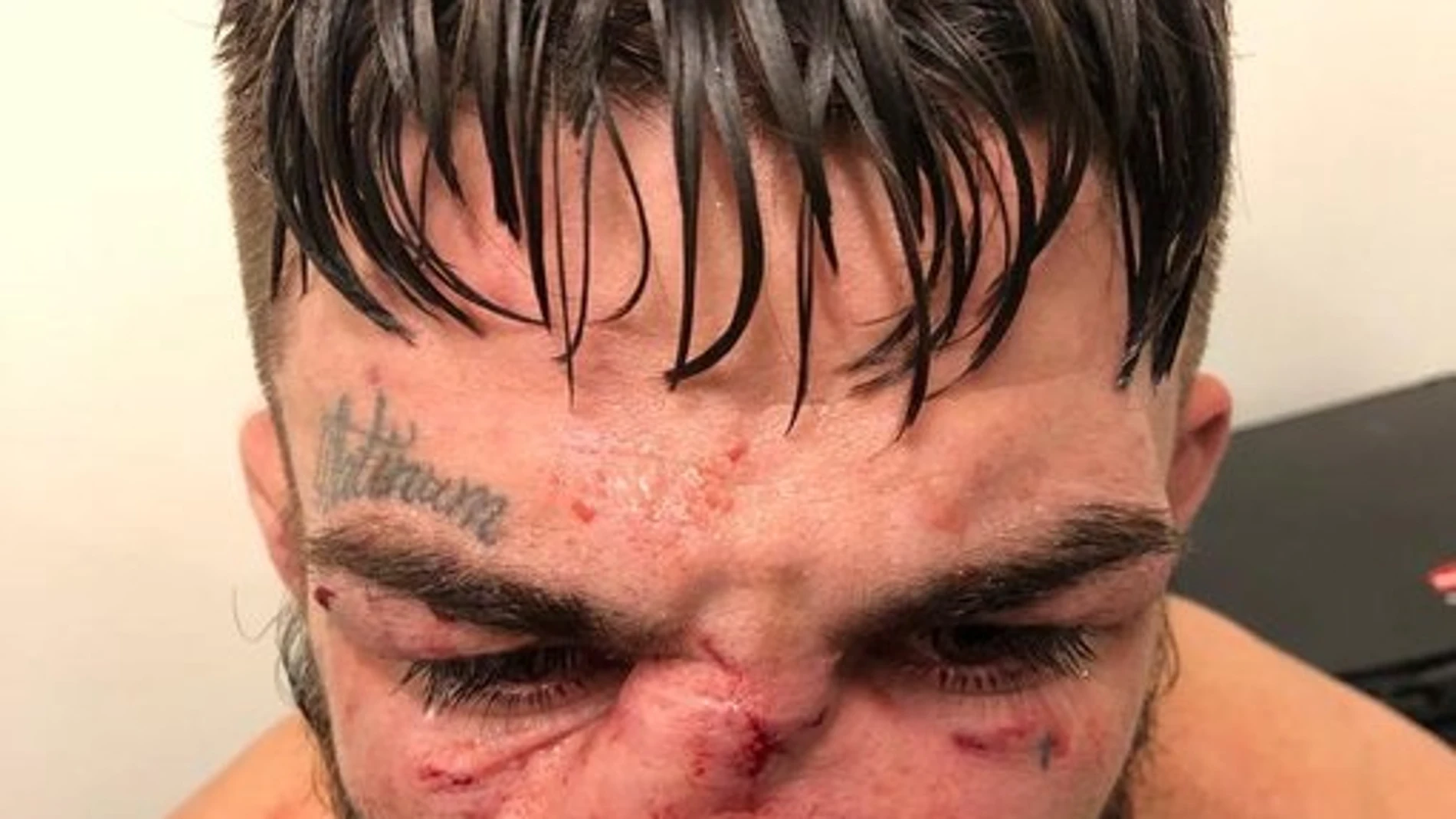 La escalofriante lesión de un luchador de la UFC